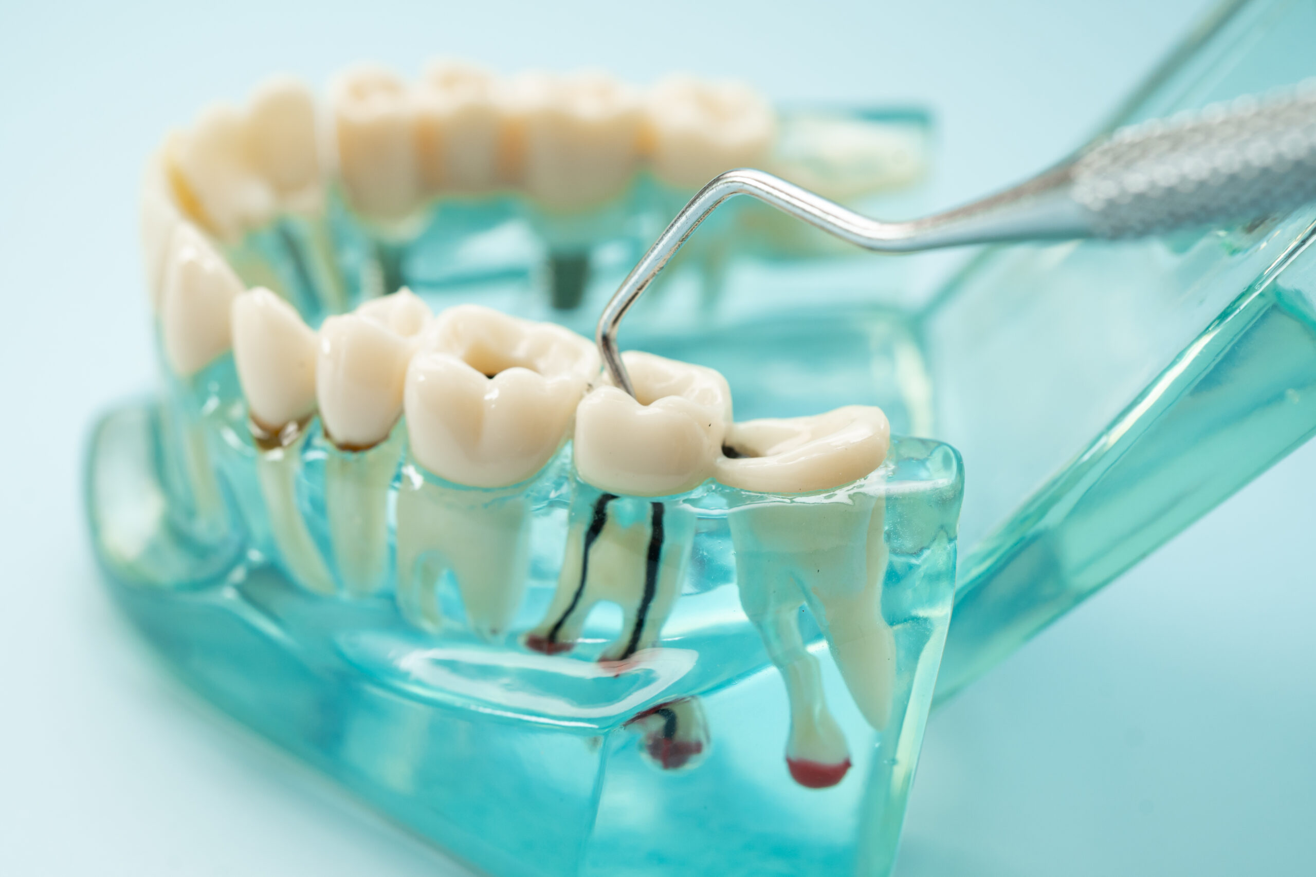 root canal treatment